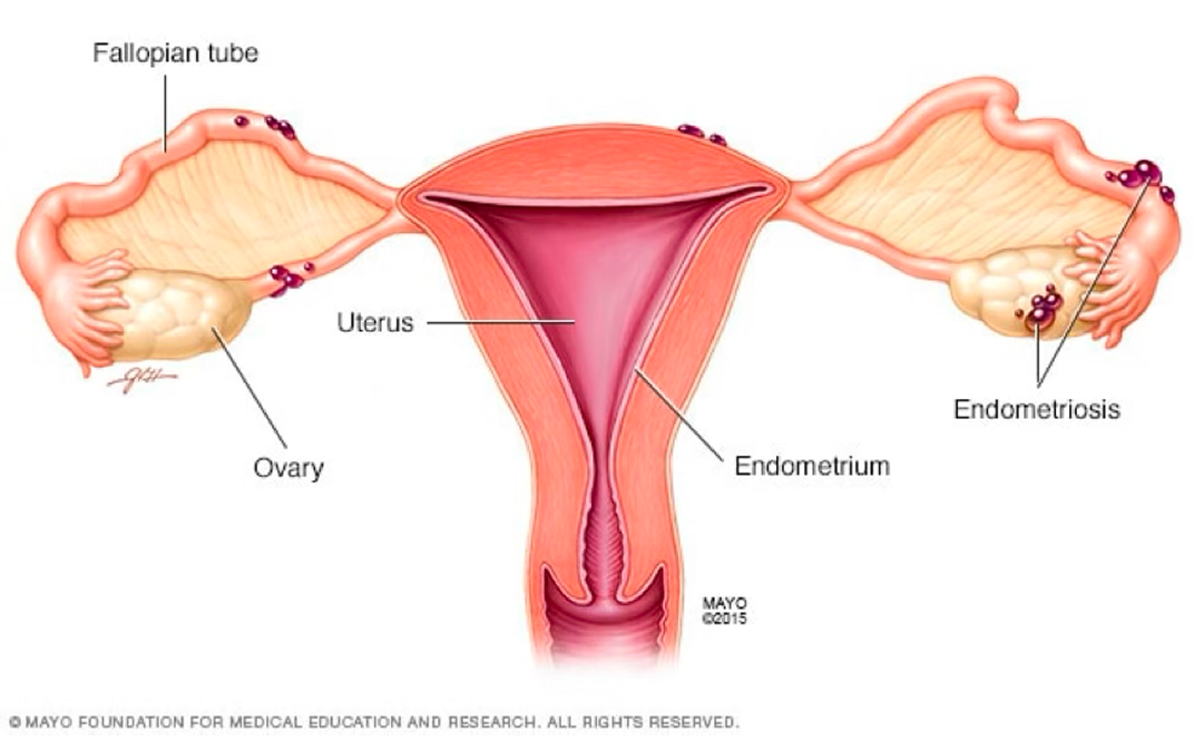 Endometriosis illustration