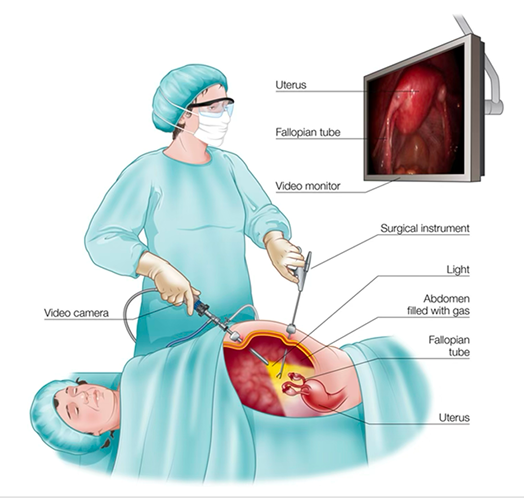 Laparoscopy procedure illustration