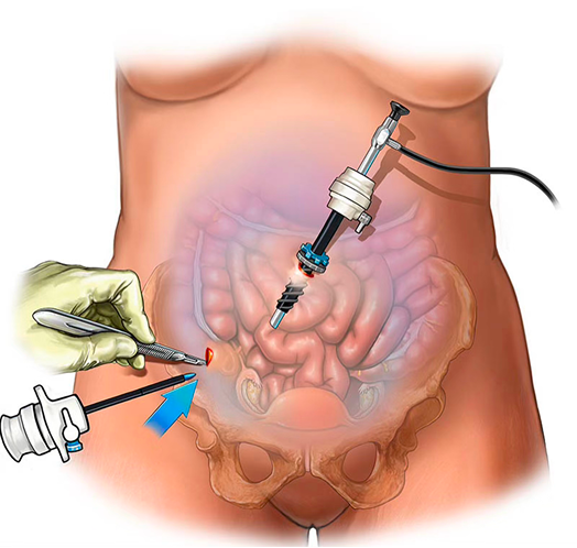 Laparoscopy procedure illustration