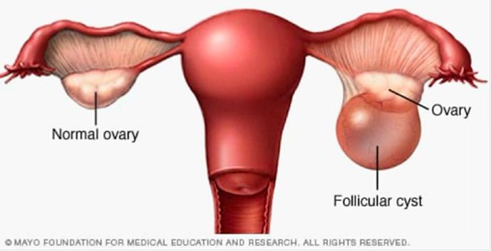 Ovarian Cyst illustration