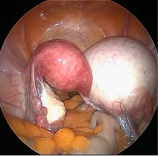 Ovarian Cyst surgical image
