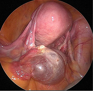 Ovarian Cyst surgical image