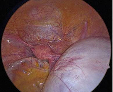Ovarian Cyst surgical image
